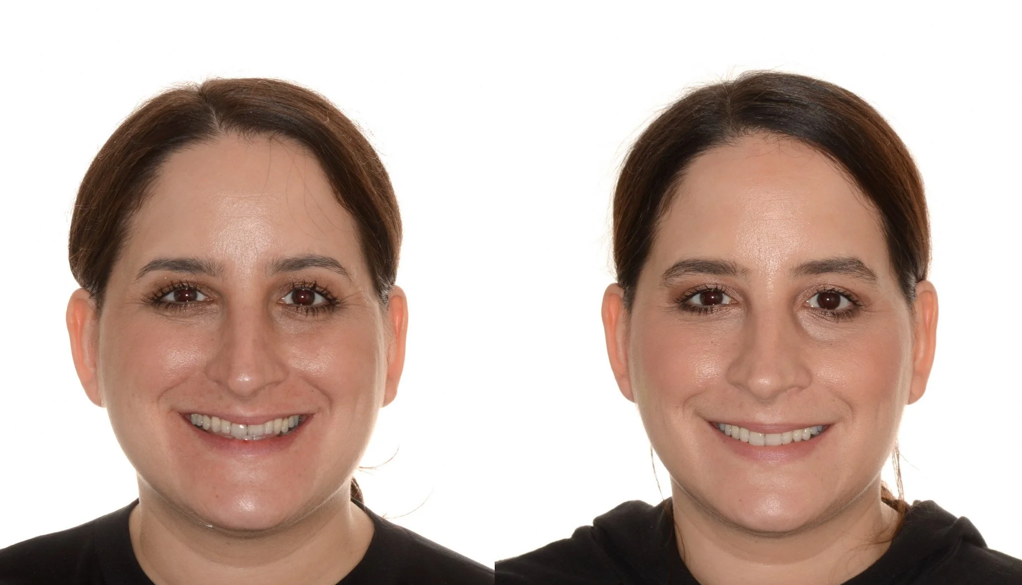 upper jaw surgery