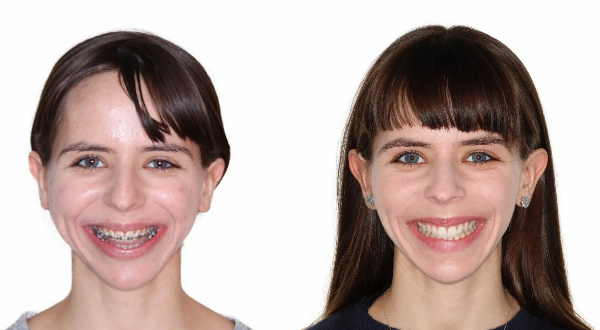 jaw-surgery-long-island.jpg