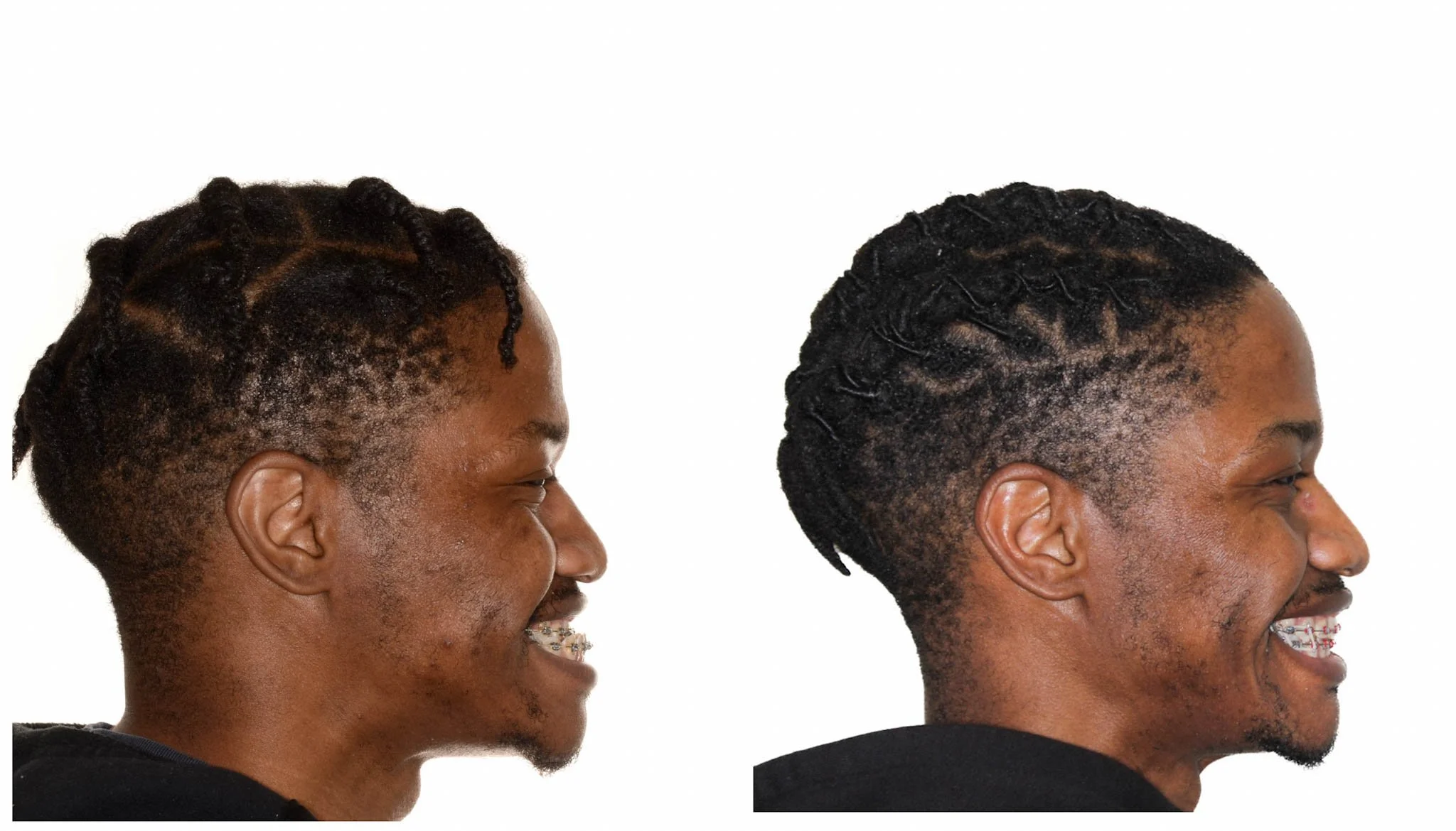 class 3 underbite correction