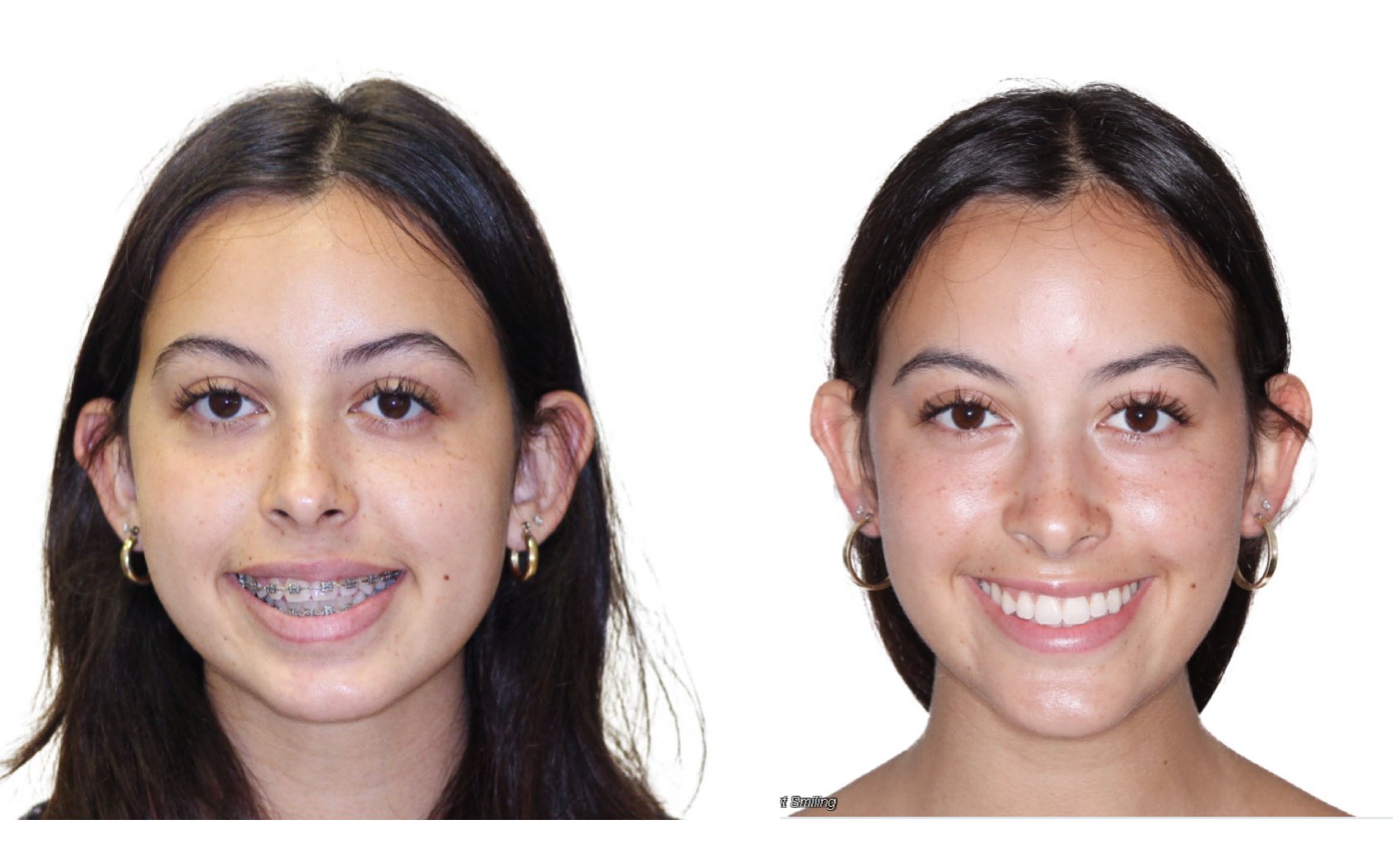 Facial asymmetry surgery