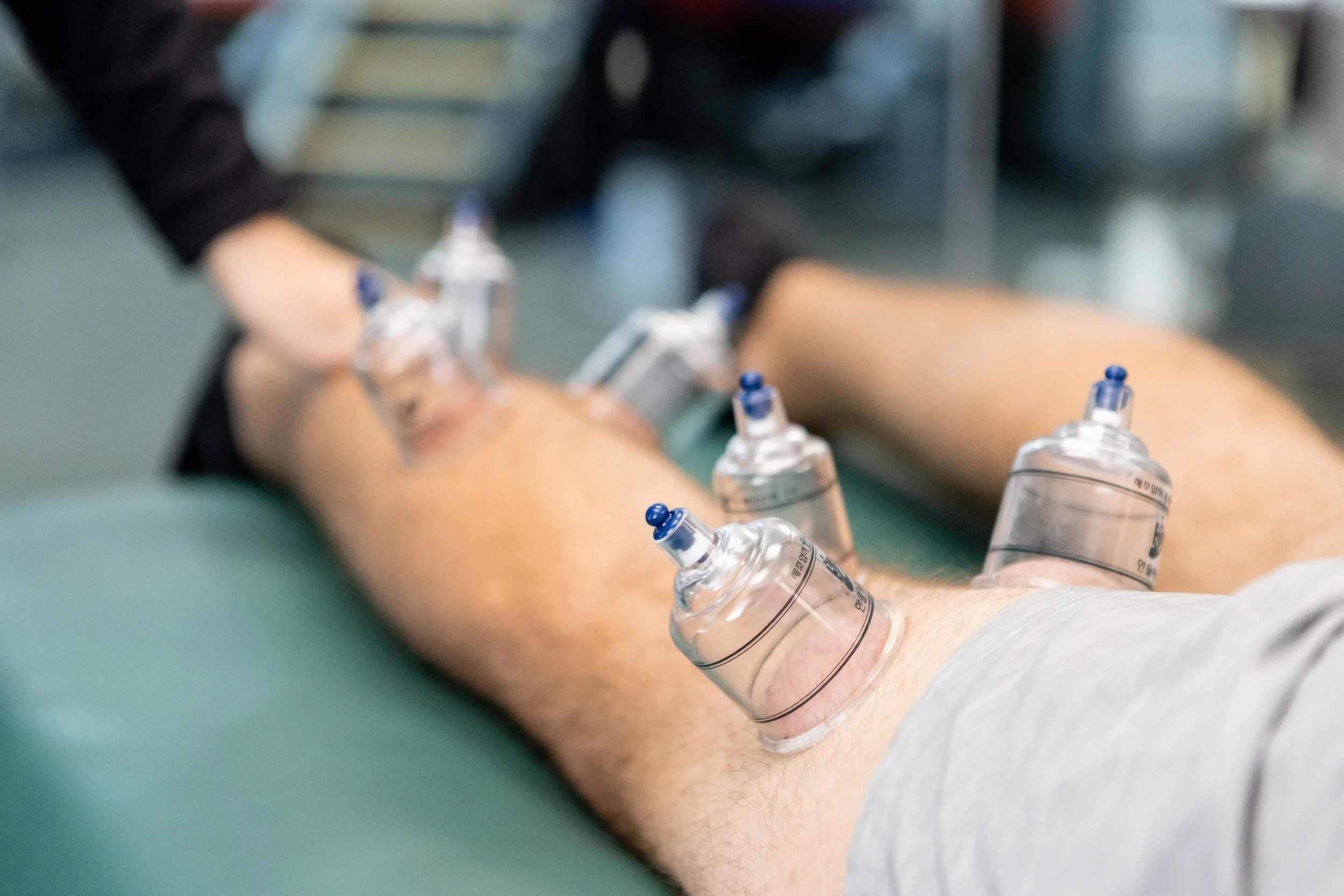 Treatment Tuesday - Cupping with Dr. Emily