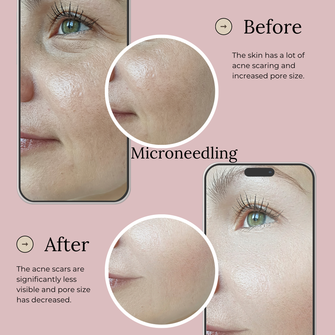 Why Microneedling as so pretty beauty bar is Orlando’s secret to radiant skin