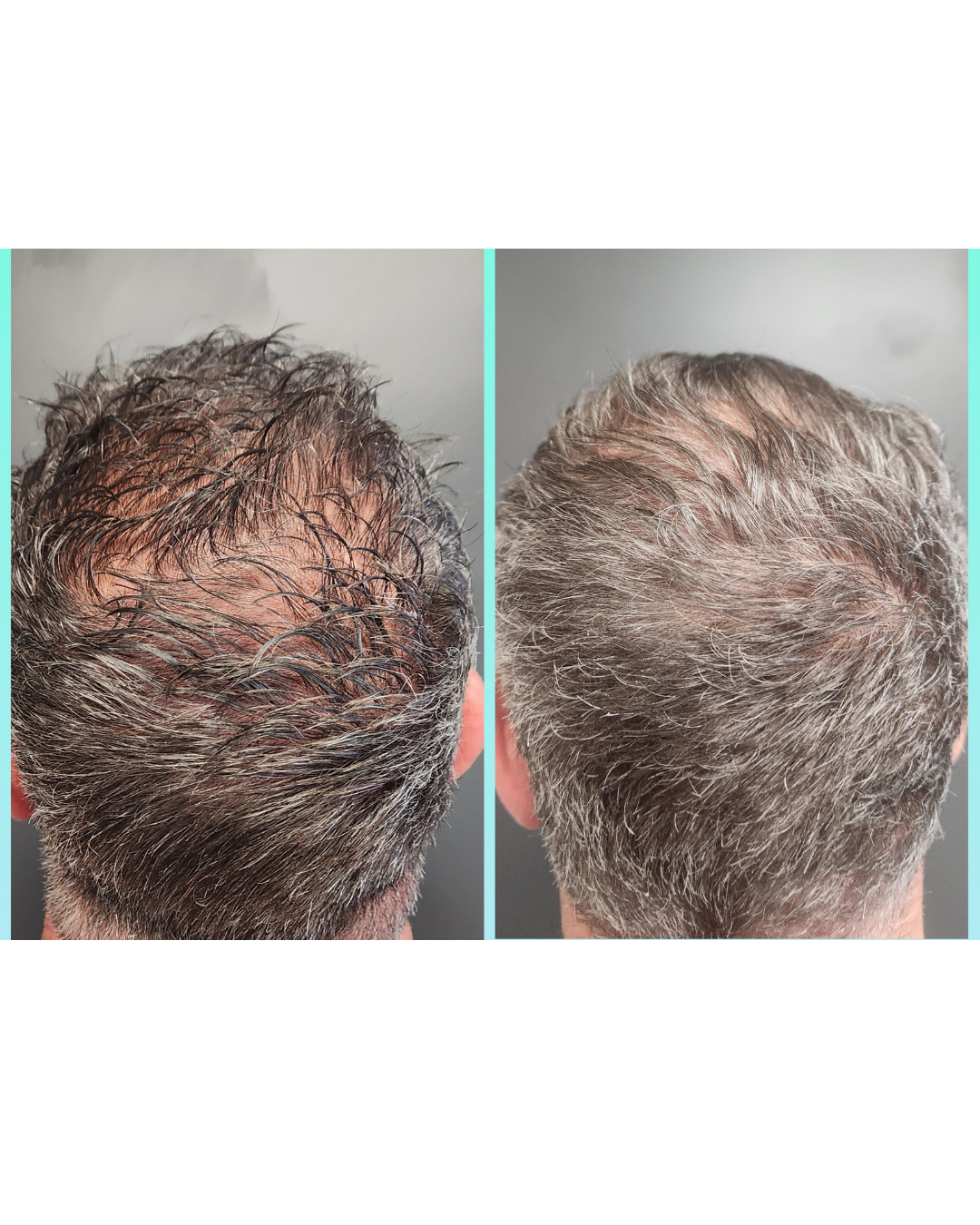 Comparison of a man's scalp before and after hair treatment, showing increased hair density and coverage.