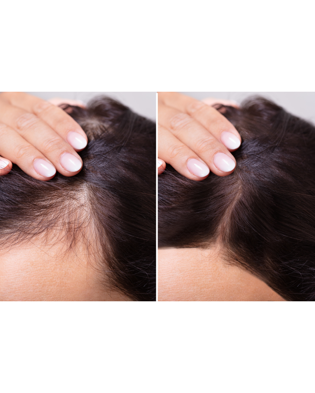 Side-by-side comparison of a woman's scalp before and after hair restoration treatment, showing fuller hair in the after image.