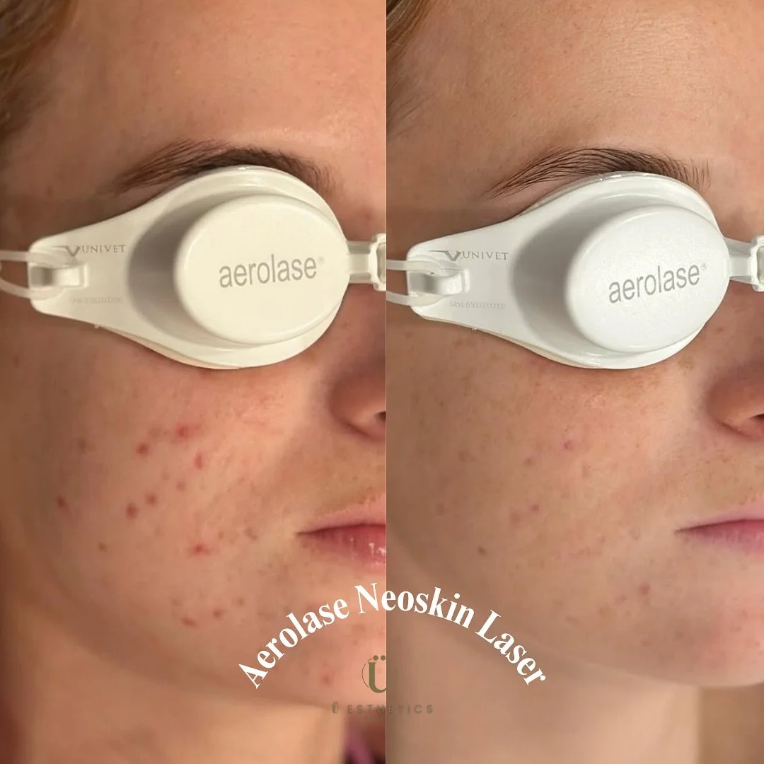 ✨ Witness the transformation! ✨ 
Say goodbye to blemishes and hello to smoother, clearer skin with the power of Aerolase NeoSkin Laser. This incredible treatment targets acne at its source, revealing a more radiant and confident you. 

🔥 Don&rsquo;t