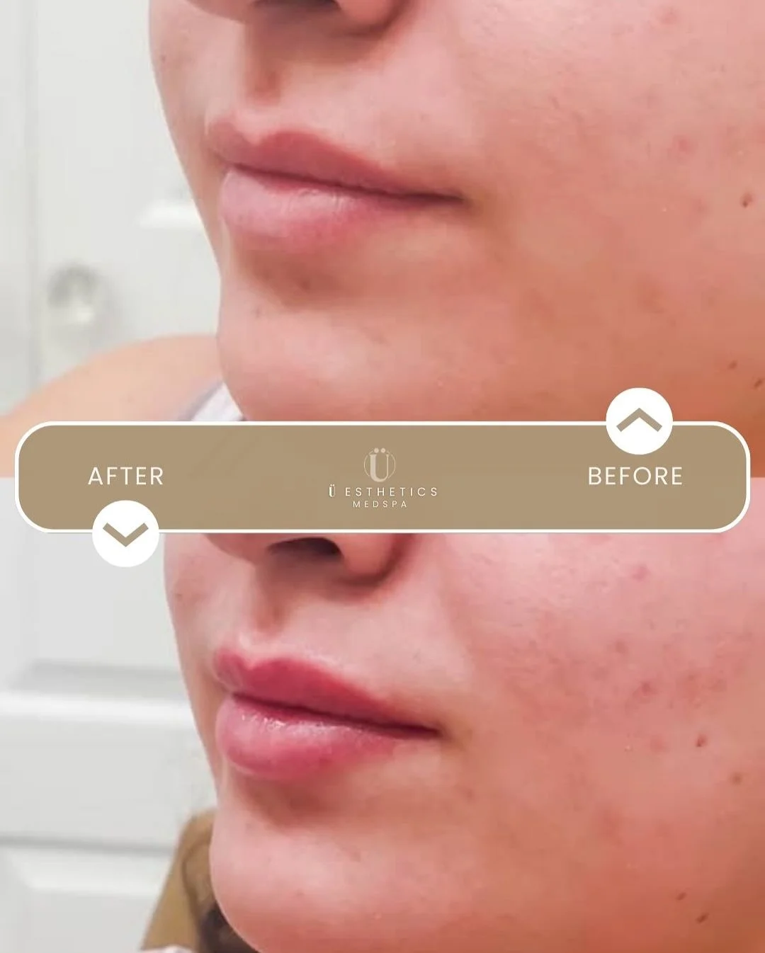 You don&rsquo;t always need a full syringe for lips to look THIS good 👄✨

This beautiful patient came for a consult to see what we could do to help with her profile, specifically with her lips. 1/2 syringe of filler made a natural difference, and sh
