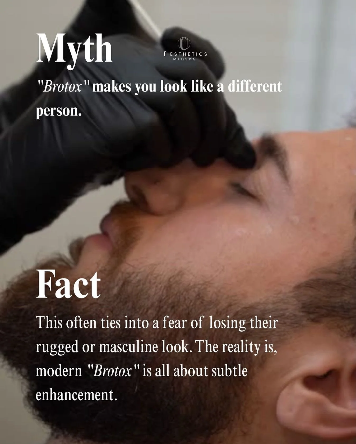 The myth stops here. 
You won&rsquo;t look &ldquo;done,&rdquo; you&rsquo;ll just look more confident.
At Uesthetics, our Brotox treatments are precision work, respecting your masculine structure while erasing years of stress. It&rsquo;s self-care, el