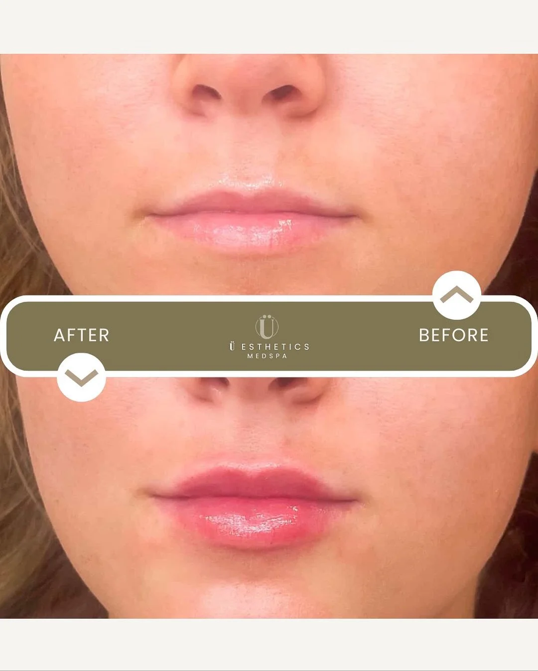 Just half a syringe&mdash;full confidence.
Refined, refreshed, 100% you.

Thinking subtle? Let&rsquo;s chat. 💋

#UestheticsTouch #LipRefresh #BeautyPersonalized #IndianaMedSpa