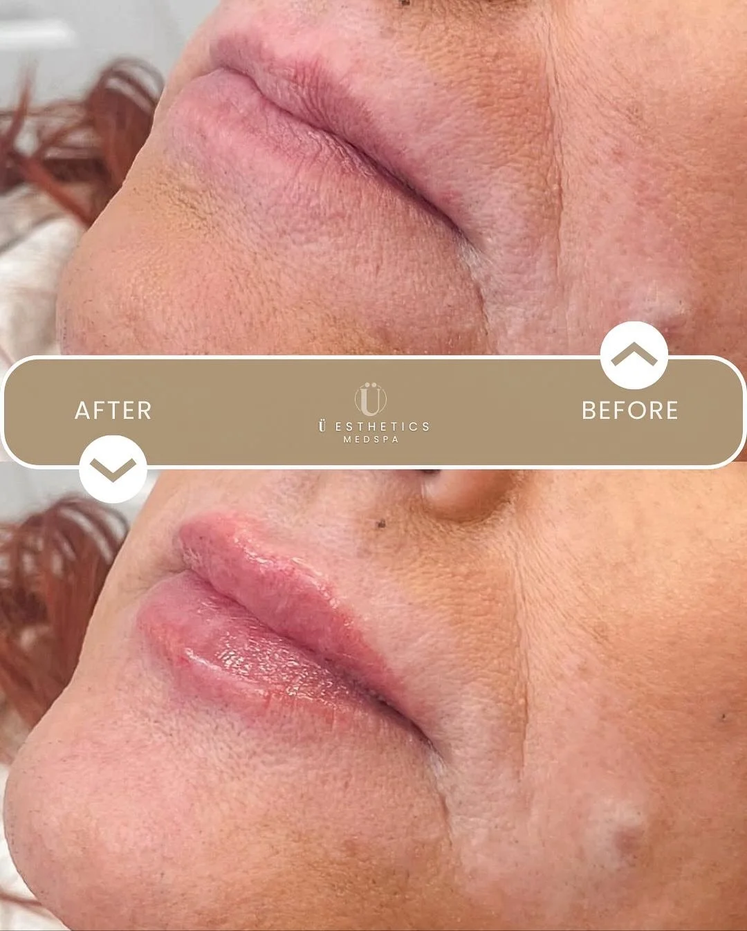 At &Uuml;esthetics, artistry meets innovation&mdash;Meghan elevated her lip transformation using our new favorite micro droplet technique, achieving balanced, beautifully enhanced lips with a natural touch.💖

Curious about what personalized enhancem