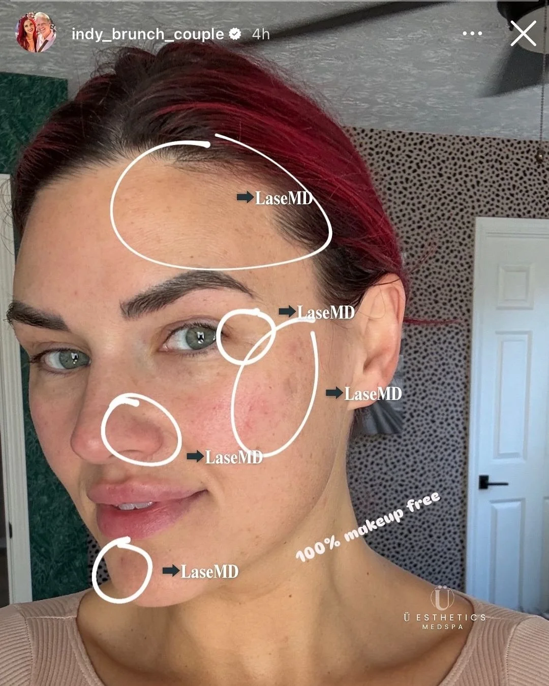 Our beautiful &Uuml;esthetics guest is makeup-free in this &ldquo;before&rdquo; shot, showing the areas about to be transformed with LaseMD Ultra. 

We&rsquo;re excited to follow her journey&mdash;stay tuned for her radiant results in just a few week