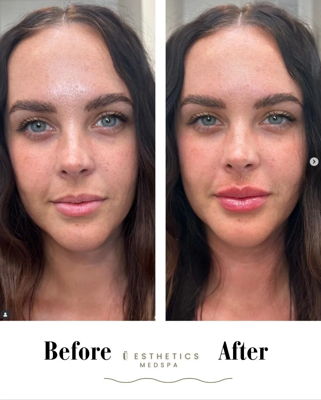 Watch her glow ✨ See the stunning transformation from natural lip enhancement!

Ready for your own confidence boost? Book your appointment now at uestheticsindy.com.

#&Uuml;estheticsIndy #LipFillerIndy #GlowUp #NaturalBeauty #ConfidenceBoost #IndyAe