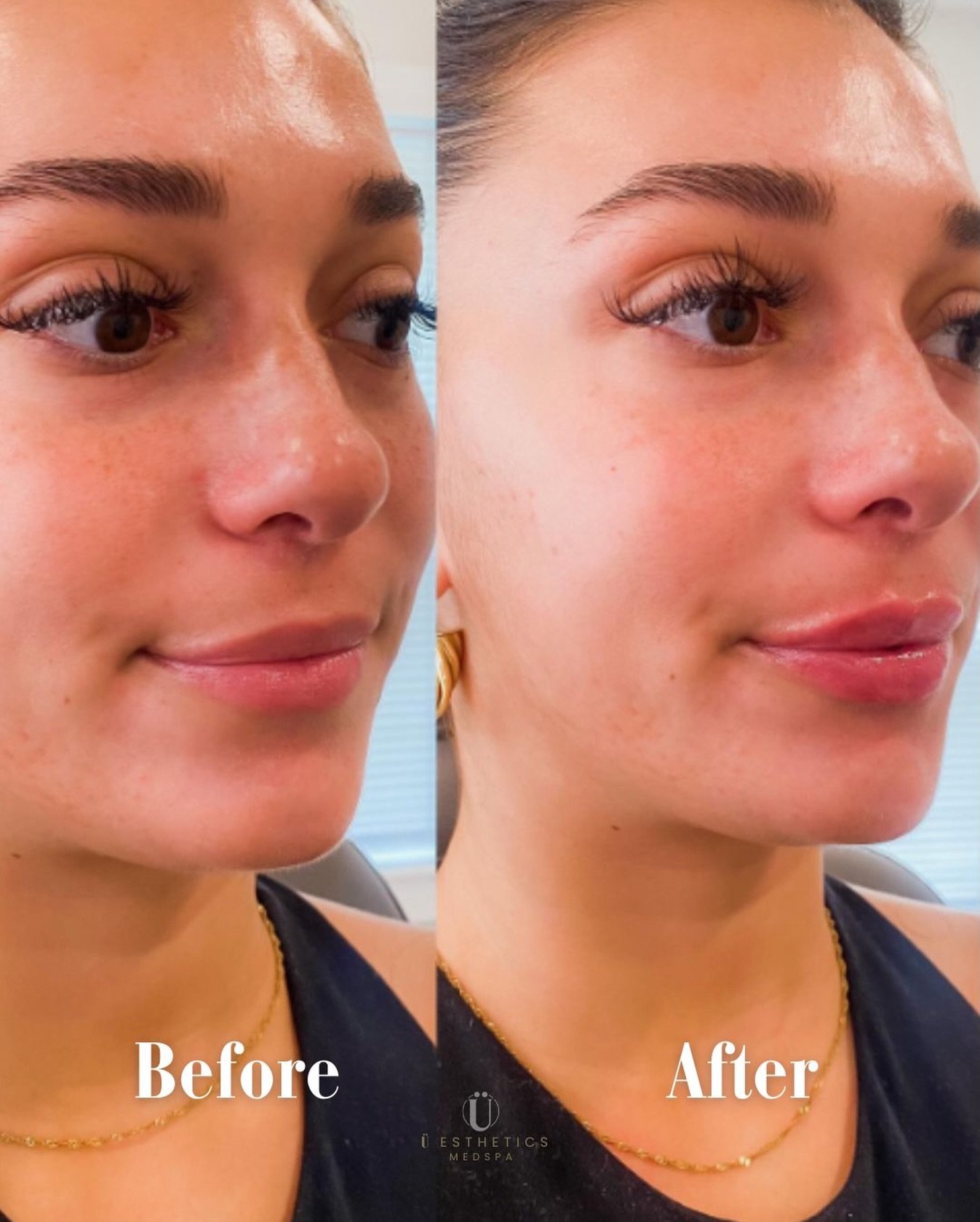 Confidence is the best accessory, but a little hydration doesn&rsquo;t hurt either. 😉

We used 1/2 a syringe to give her a soft, pillowy enhancement. It&rsquo;s sophisticated, natural, and undeniably her. Ready to glow? DM us to chat about your goal
