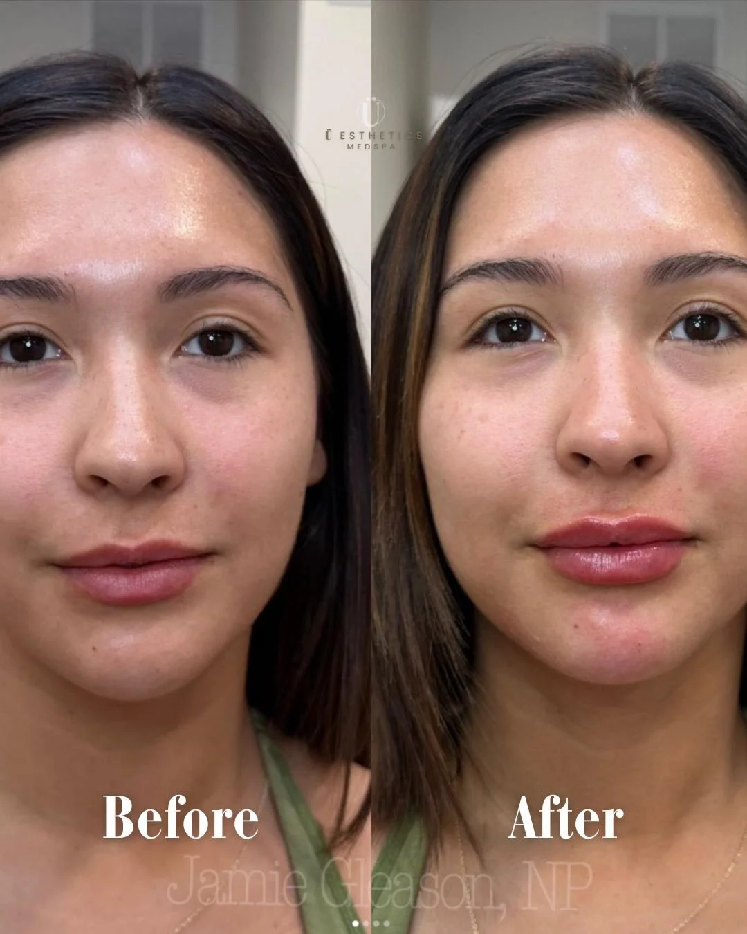 Upper Lip Volume + Lower Lip Hydration = Perfection 💉

We love a natural lip enhancement that brings balance and a beautiful glow. This is the difference expertise makes!

Book your lip appointment now! ➡️ uestheticsindy.com