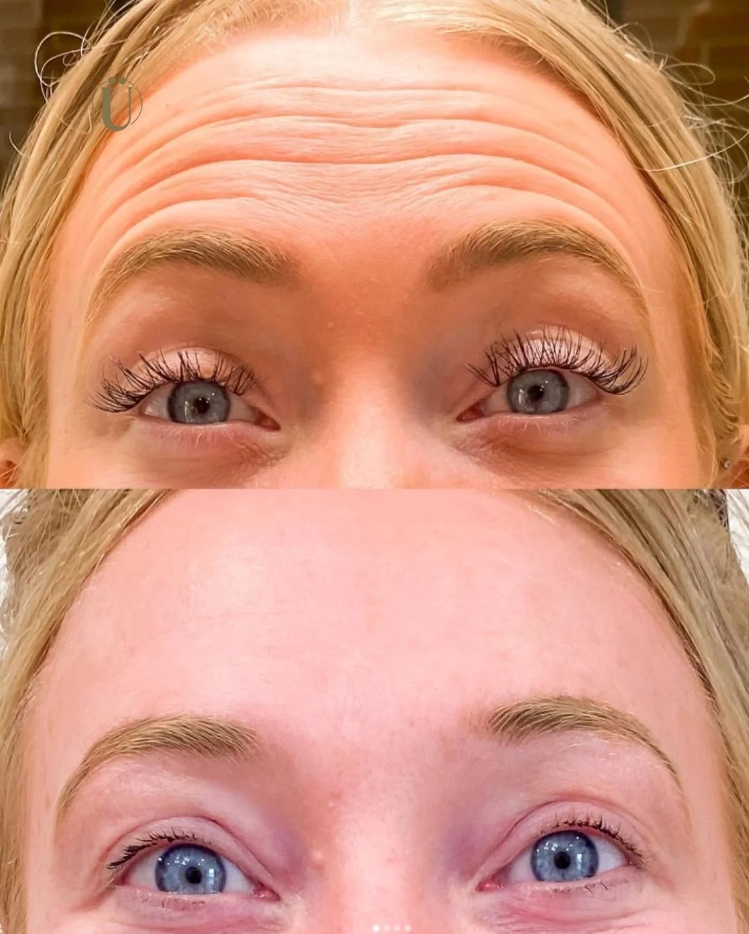 It&rsquo;s amazing what a little tox can achieve 💉✨
When it&rsquo;s done right, it&rsquo;s subtle. Fresh. Natural.
Just a smoother, more relaxed version of you.

Book your tox appointment with &Uuml;esthetics and let&rsquo;s get you glowing.

👉 Lin