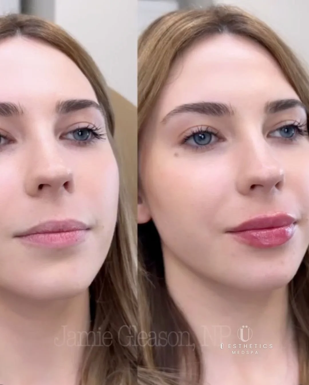 A Holiday Glow-Up We Couldn&rsquo;t Keep to Ourselves ✨
While the world is busy unwrapping gifts, we&rsquo;re still swooning over these stunning results.
Consider this our little holiday gift to your feed. 🎁
Ready to step into the New Year feeling y