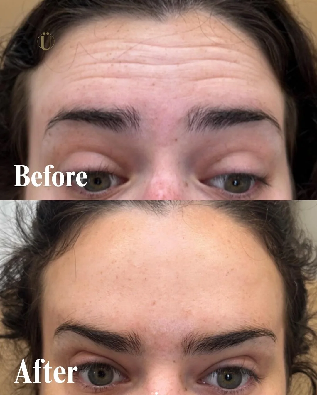 POV: I just want a smooth forehead&hellip; not a frozen one.
Yes, we do this every day, softening lines while keeping your natural expression and glow.✨

Book your neurotoxin consult at&nbsp;uestheticsindy.com.
 #&Uuml;estheticsIndy #NeurotoxinIndy #