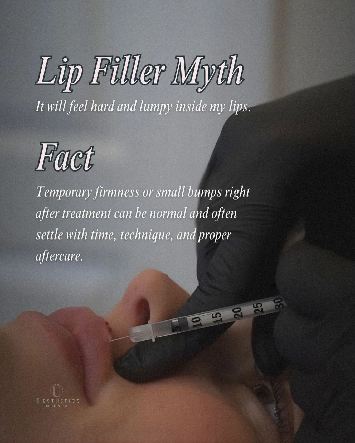 Myth: Lip filler will feel hard and lumpy. 🚫
Fact: Temporary firmness is a natural part of the healing process. While small bumps can occur immediately post-treatment, they typically settle within 1&ndash;2 weeks as the filler integrates with your t
