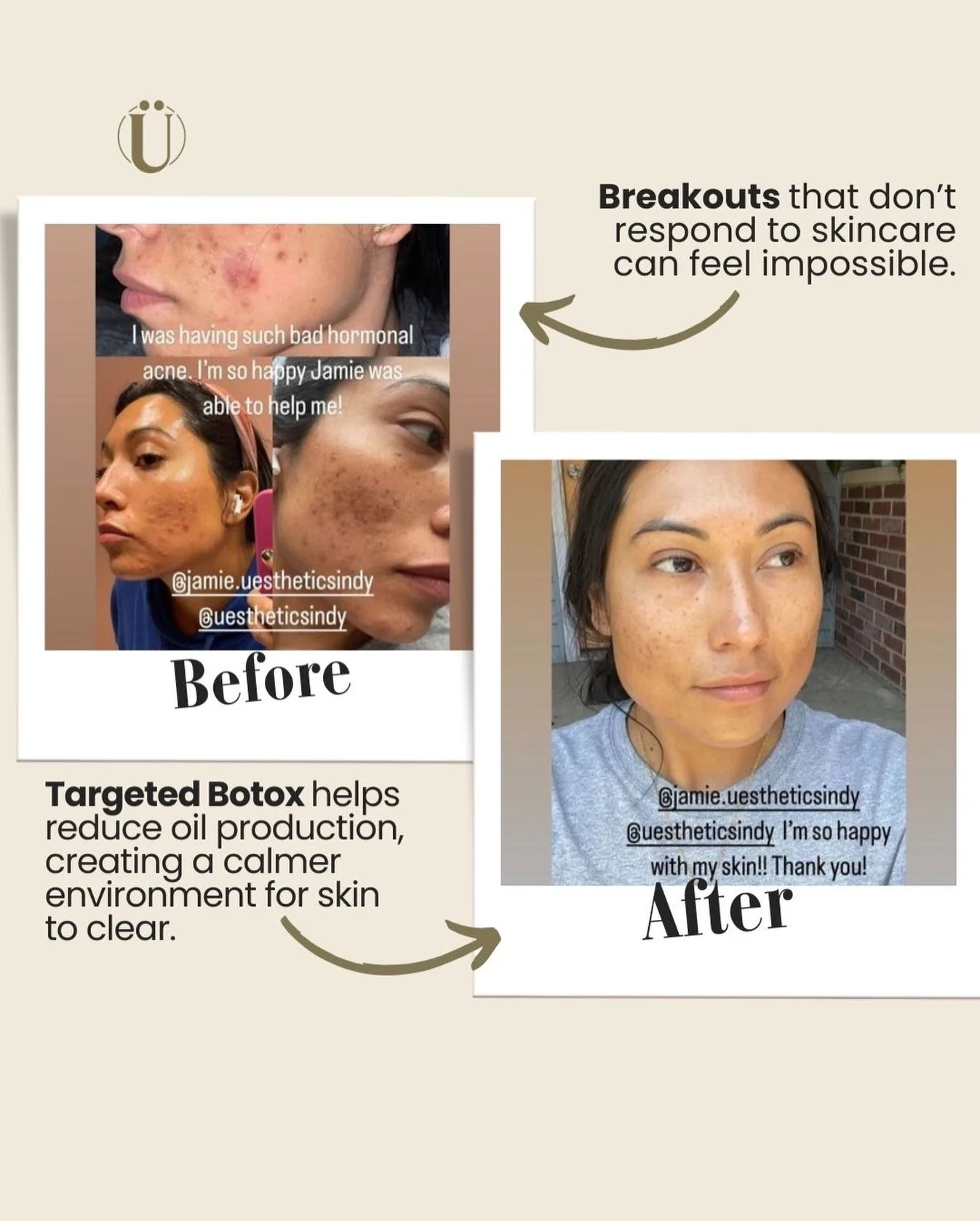 You&rsquo;ve tried everything&mdash;clean skincare, actives, facials&mdash;and the breakouts still won&rsquo;t budge. Hormonal acne is stubborn like that.
 Targeted Botox can actually reduce oil production, creating a calmer environment where skin ca