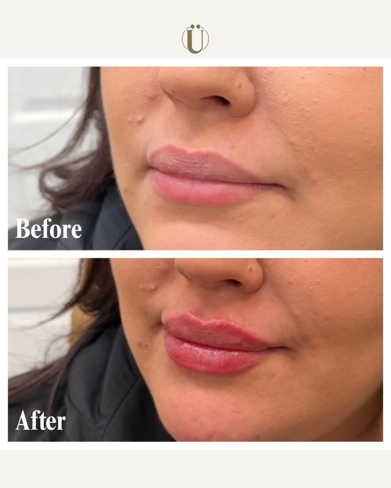 Ever feel like lip filler always looks too obvious&hellip; or not noticeable at all? 😁
That fear keeps many people on the fence.

When it&rsquo;s done correctly, lip filler doesn&rsquo;t look &ldquo;done.&rdquo; It looks like you&mdash;just refreshe