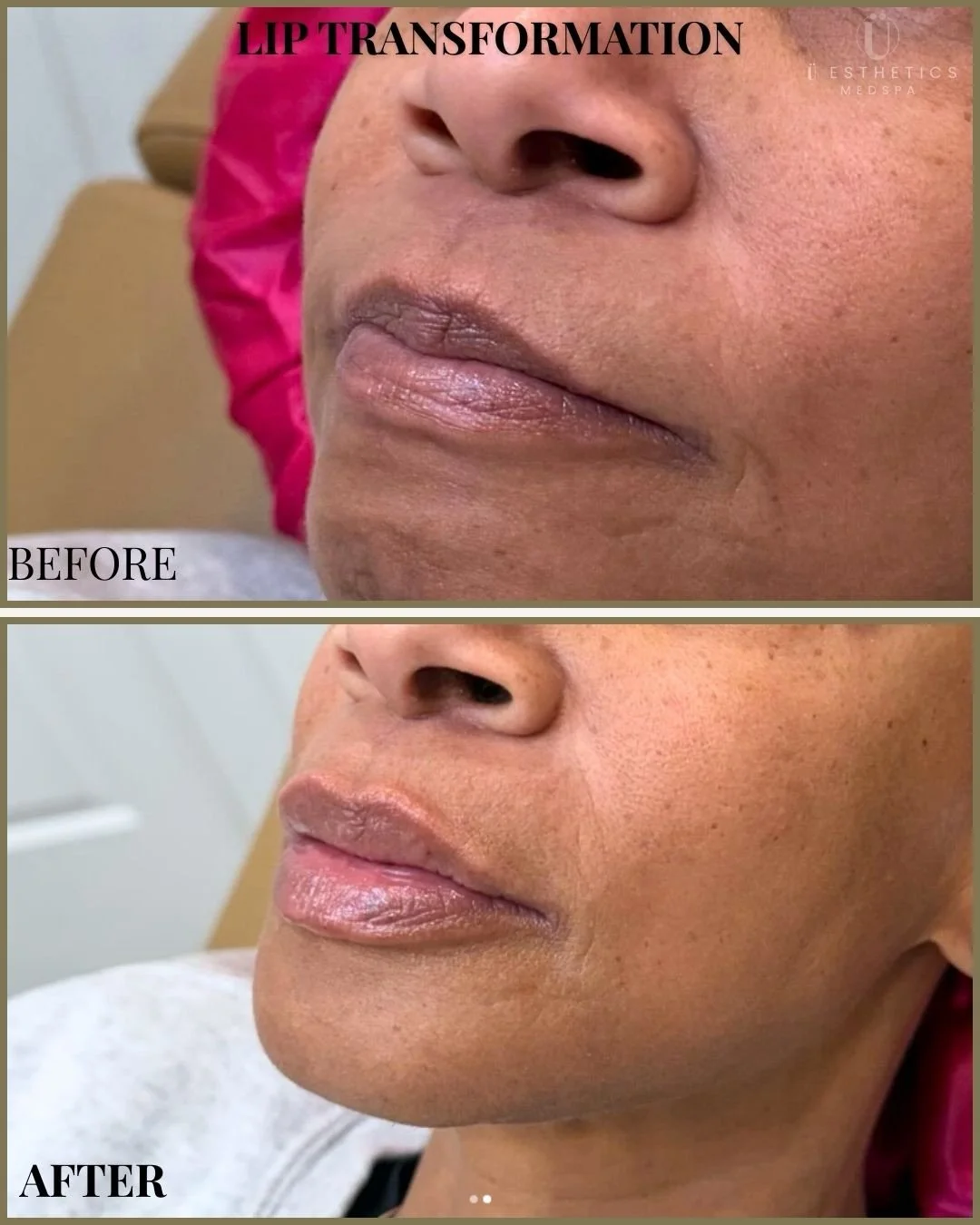 Where did my lips go?&rdquo; It&rsquo;s the #1 question we hear. As we age, our lips don&rsquo;t just lose volume, they lose their structure, causing them to turn inward and look dehydrated. You don&rsquo;t necessarily want &ldquo;big&rdquo; lips; yo