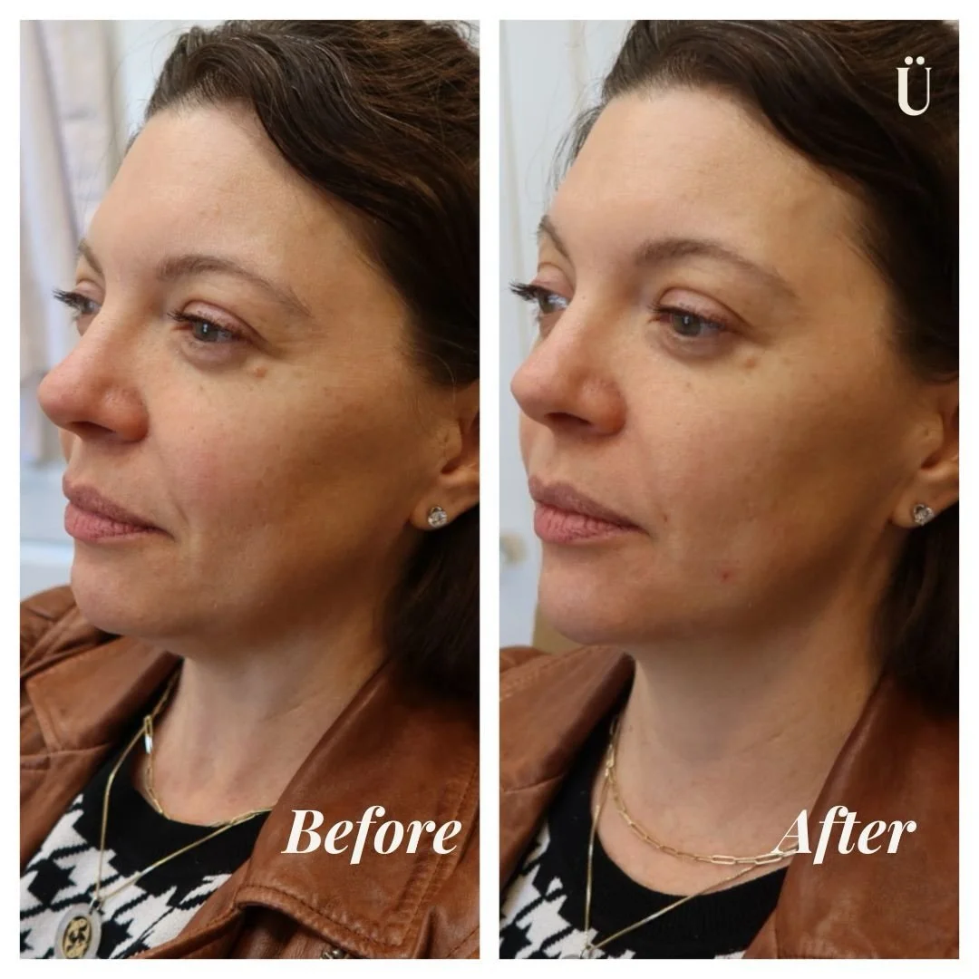 A shadowed chin can make the entire lower face look uneven.
 Strategic chin balancing smooths dimpling and improves projection with precision placement.
 Refined. Balanced. Undetectable.
 Comment CHIN if this caught your eye. ✨

#Uesthetics #Uestheti