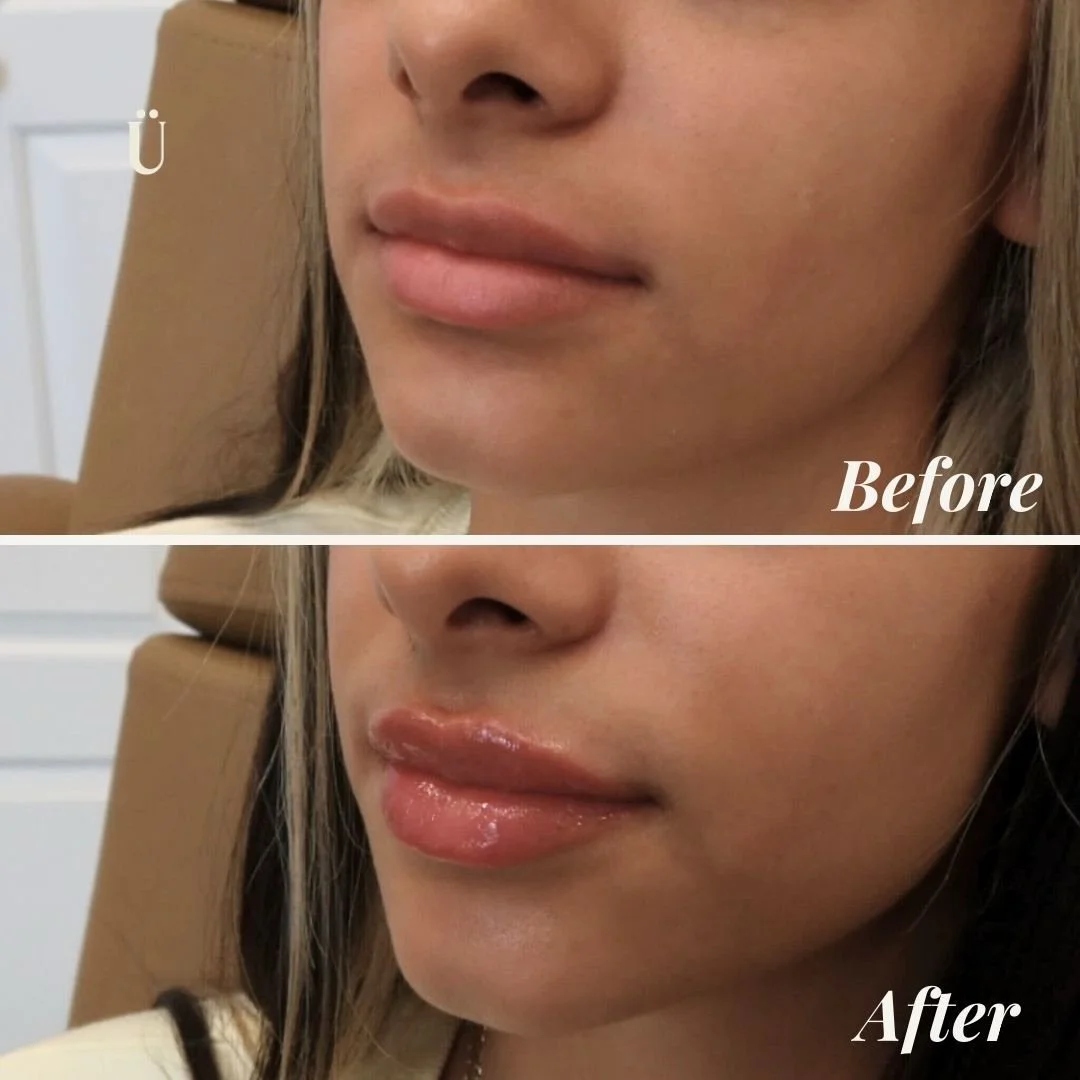 Lips starting to look a little flat, uneven, or losing that soft shape you used to love?

With strategic lip filler, we restored volume, enhanced symmetry, and added natural-looking hydration&mdash;nothing overdone, just beautifully balanced lips.

T