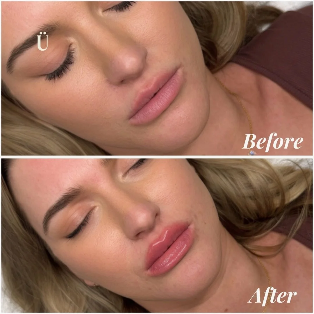 The art of a balanced profile. 📐✨
True refinement isn&rsquo;t found in a single feature, it&rsquo;s found in how those features speak to each other. Swipe to see the evolution.
By focusing on structural support rather than just volume, we were able 