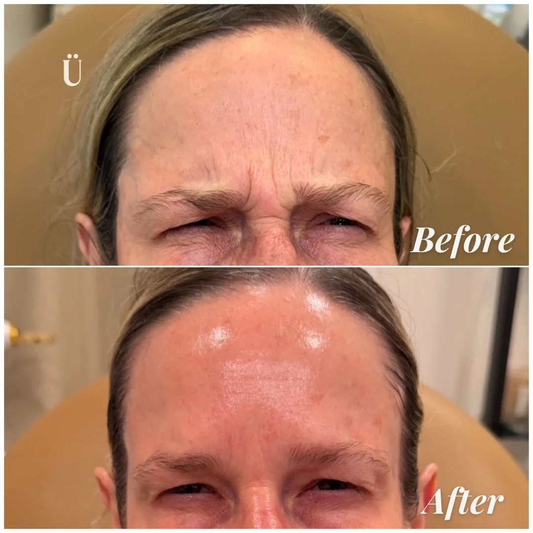 The art of the Quiet refresh. ☁️✨

True refinement isn&rsquo;t about erasing every line&mdash;it&rsquo;s about softening the canvas so yo&Uuml;r natural expression can shine through. Swipe to see the evolution of this forehead smoothing session.

By 