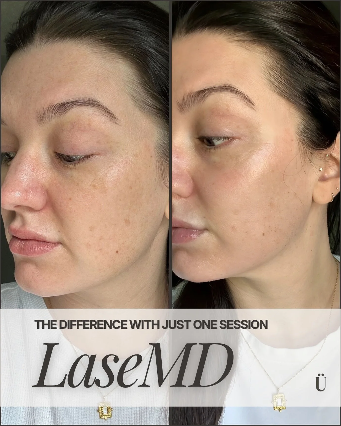 It&rsquo;s hard to believe this is the difference after just one LaseMD session at uesthetics. By targeting pigmentation and sun damage at the source, we&rsquo;re able to reveal a clearer, more even complexion without the extensive downtime.
Ready to
