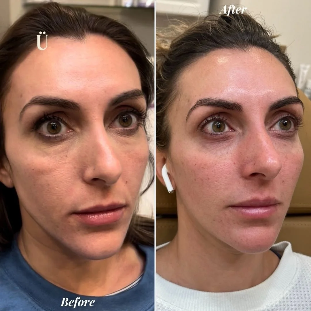 The beauty of a Sculptra 🏗️✨
True refinement doesn&rsquo;t happen overnight.

Unlike traditional methods, this Foundation Builder works with yo&Uuml;r own anatomy to stimulate collagen growth from the inside out. We aren&rsquo;t just adding volume; 