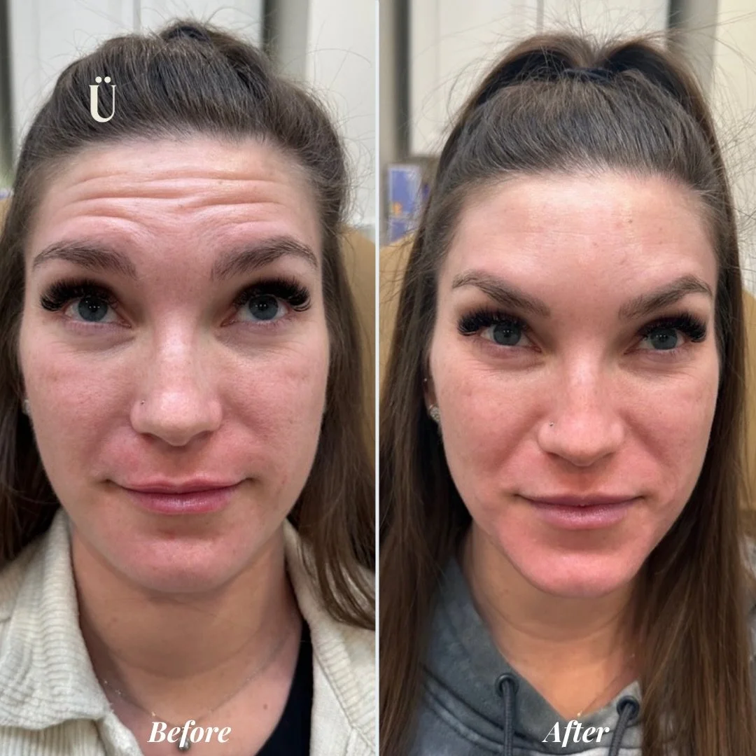 Turning down the visual static.☁️✨

When we talk about forehead smoothing, we aren&rsquo;t looking to erase your ability to communicate. We&rsquo;re looking to remove the static, those resting lines that can make the canvas look tired or stressed.
Sw