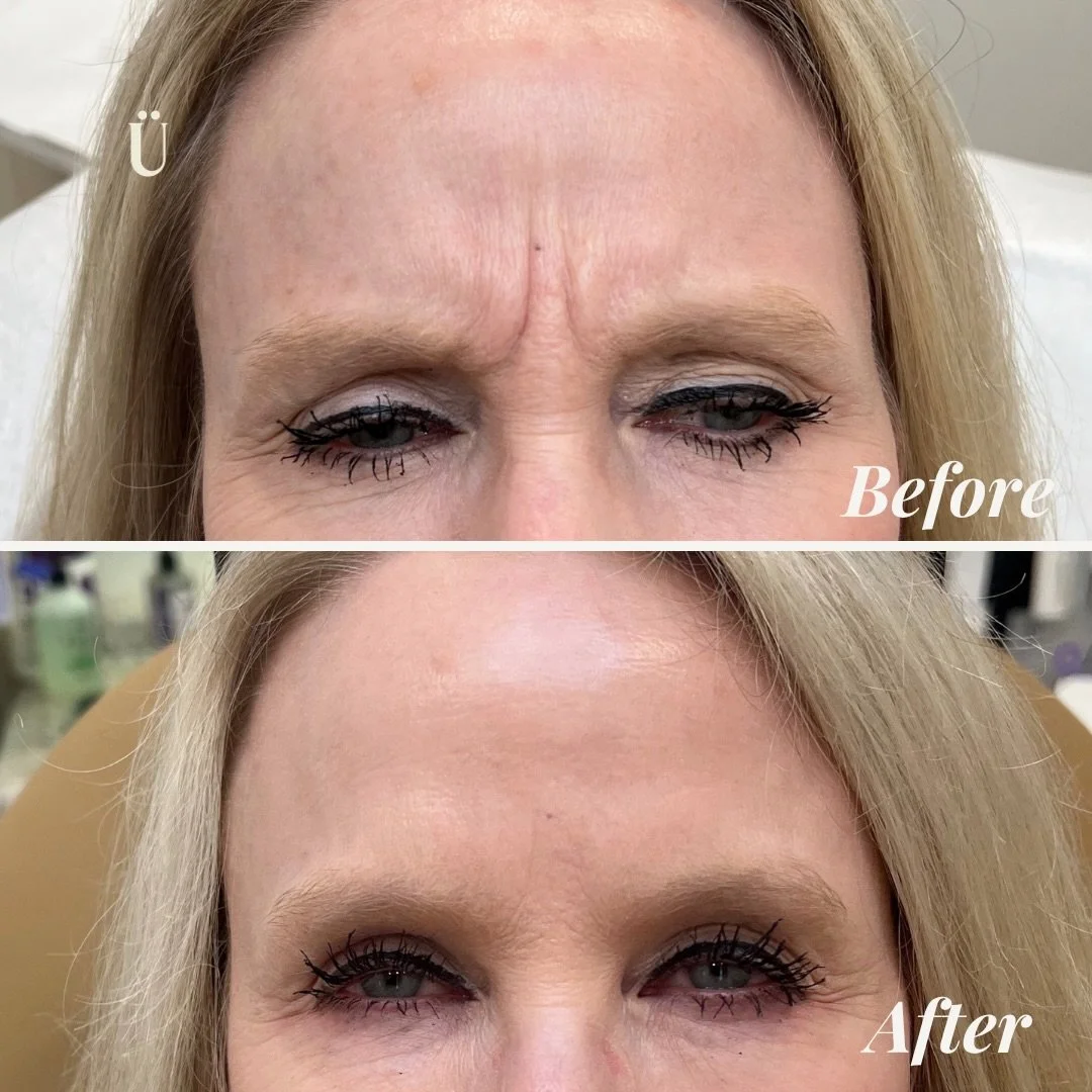 Confidence in every expression.

Smooth, refreshed, and undeniably you. Sometimes a subtle refresh is all it takes to align your outer glow with your inner energy.

Link in bio to schedule your consultation.

#Uesthetics #MedicalAesthetics #IndyMedSp