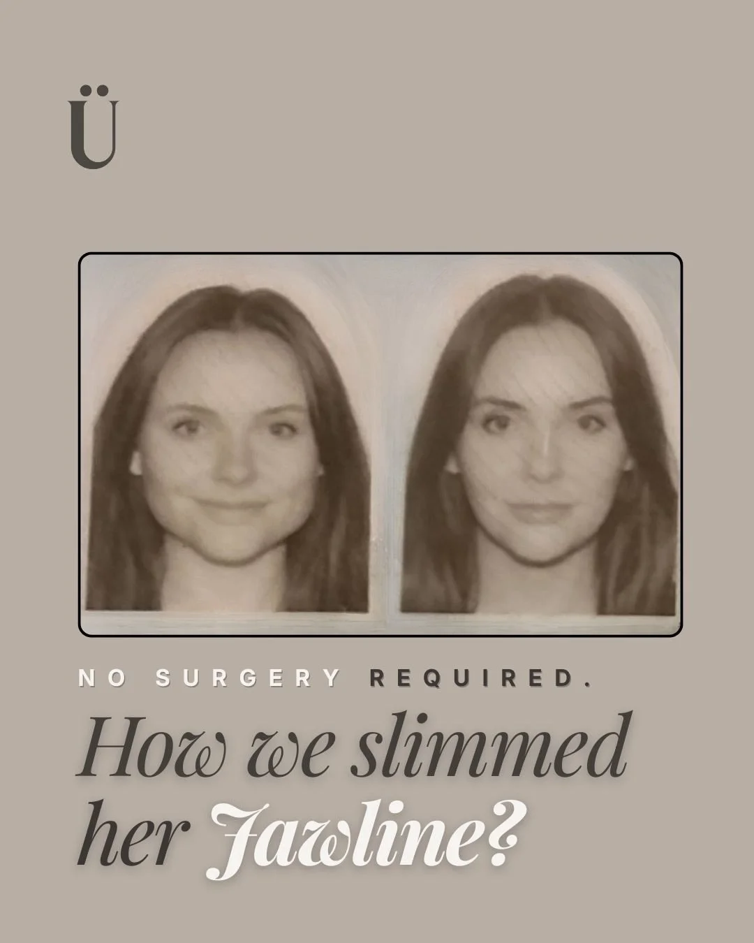 Masseter tox 101 💉
If you&rsquo;ve ever wondered why some people have a wider, more square jawline, the answer is often the masseter muscle.

This treatment helps by relaxing that muscle over time, which can:

soften the jawline

reduce clenching an
