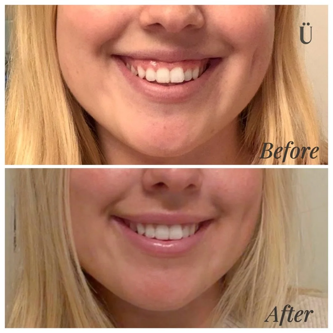 Less gum, more pout. The lip flip does both. 👄

#uesthetics #indymedspa #indianapolismedspa #lipflip #lipgoals