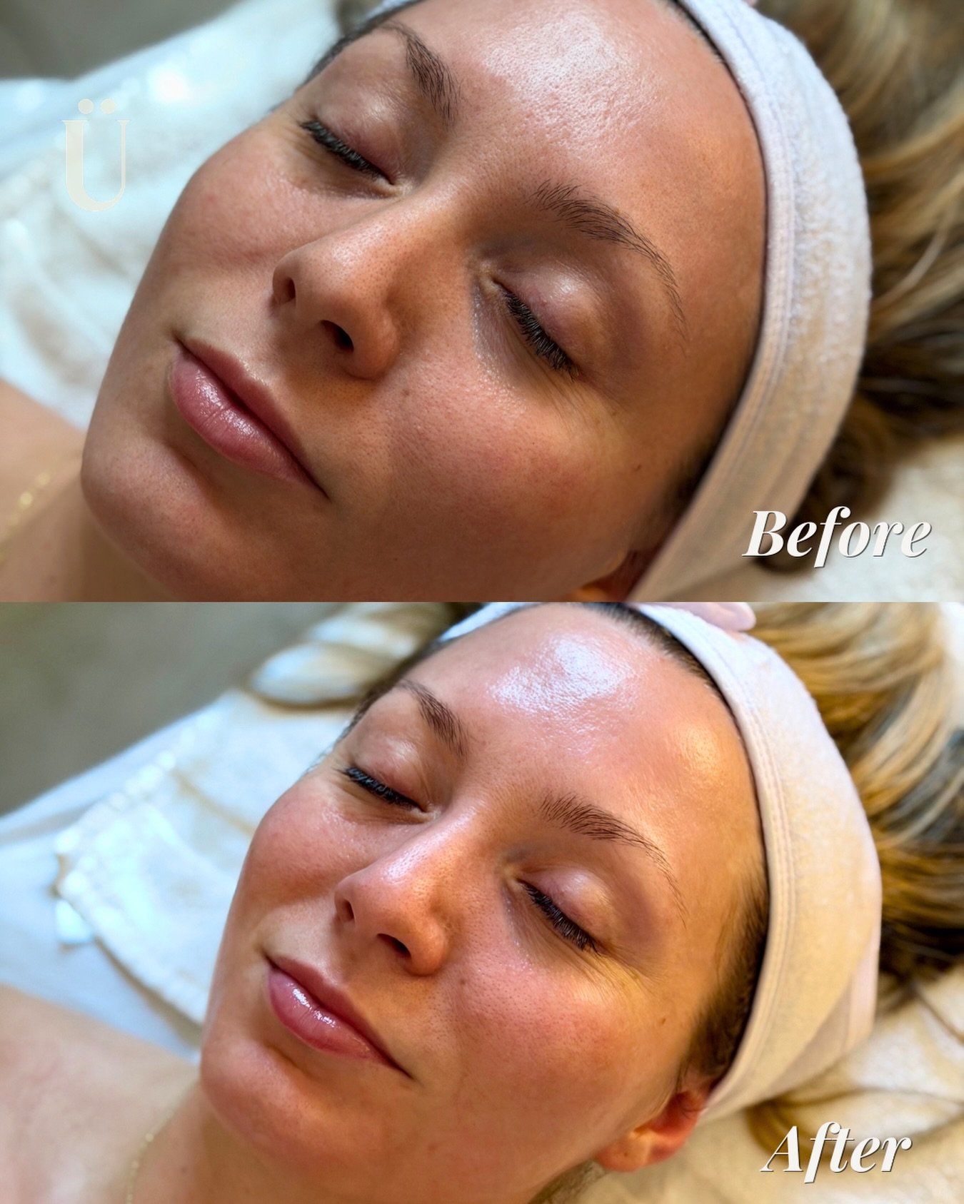 No two skin journeys are the same&mdash;which is why your facial shouldn&rsquo;t be either. ✨

Each treatment is customized to your skin&rsquo;s needs that day and includes dermaplaning for an instantly smoother, brighter complexion.

For the best re