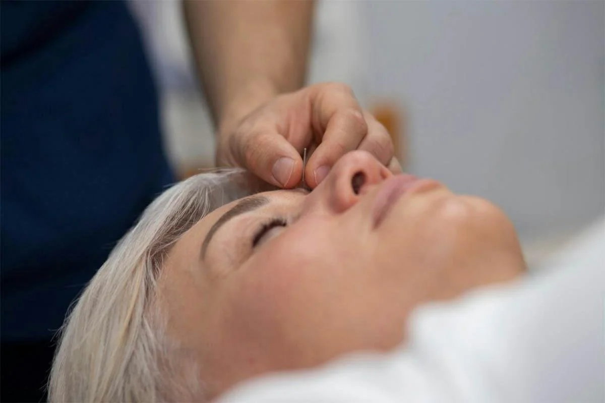 Unlock Migraine Relief Through Dry Needling Sessions — Functional