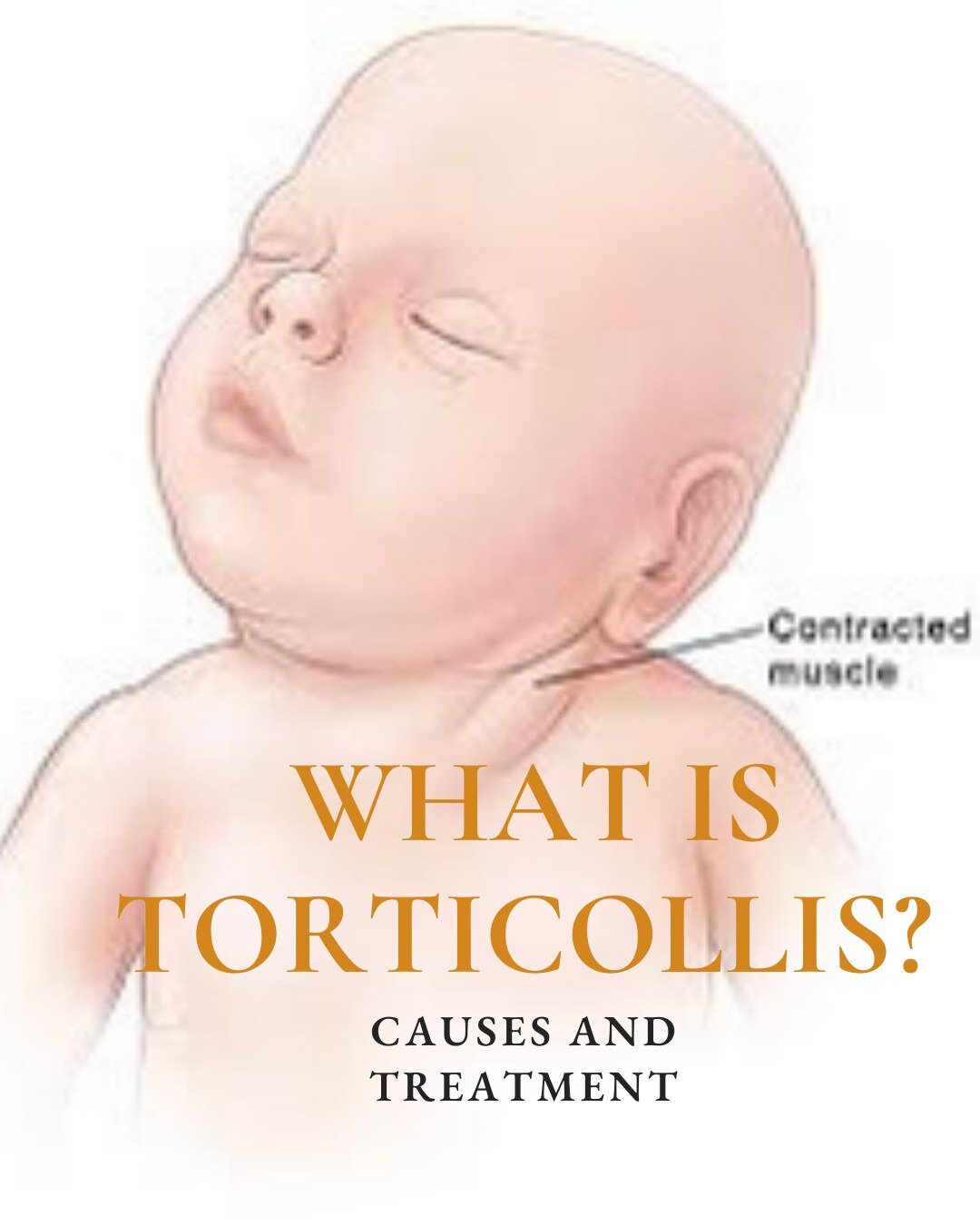 🌟 Understanding Torticollis in Babies 🌟
Did you know that babies can also experience torticollis? It's a condition where a baby's neck muscles tighten, causing their head to tilt to one side. It's more common than you might think, but with early de