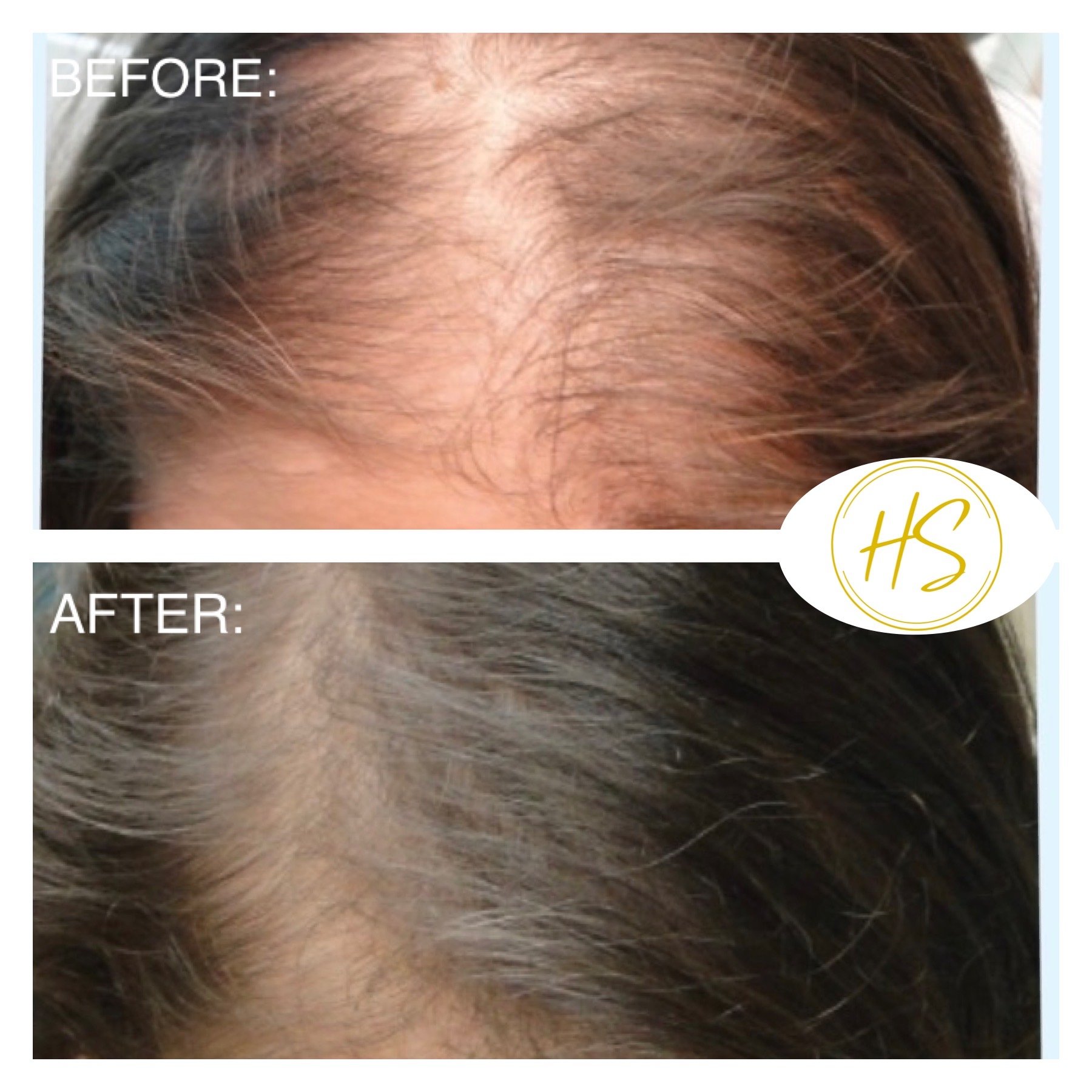 Dublin Hair Treatment PRP Injections