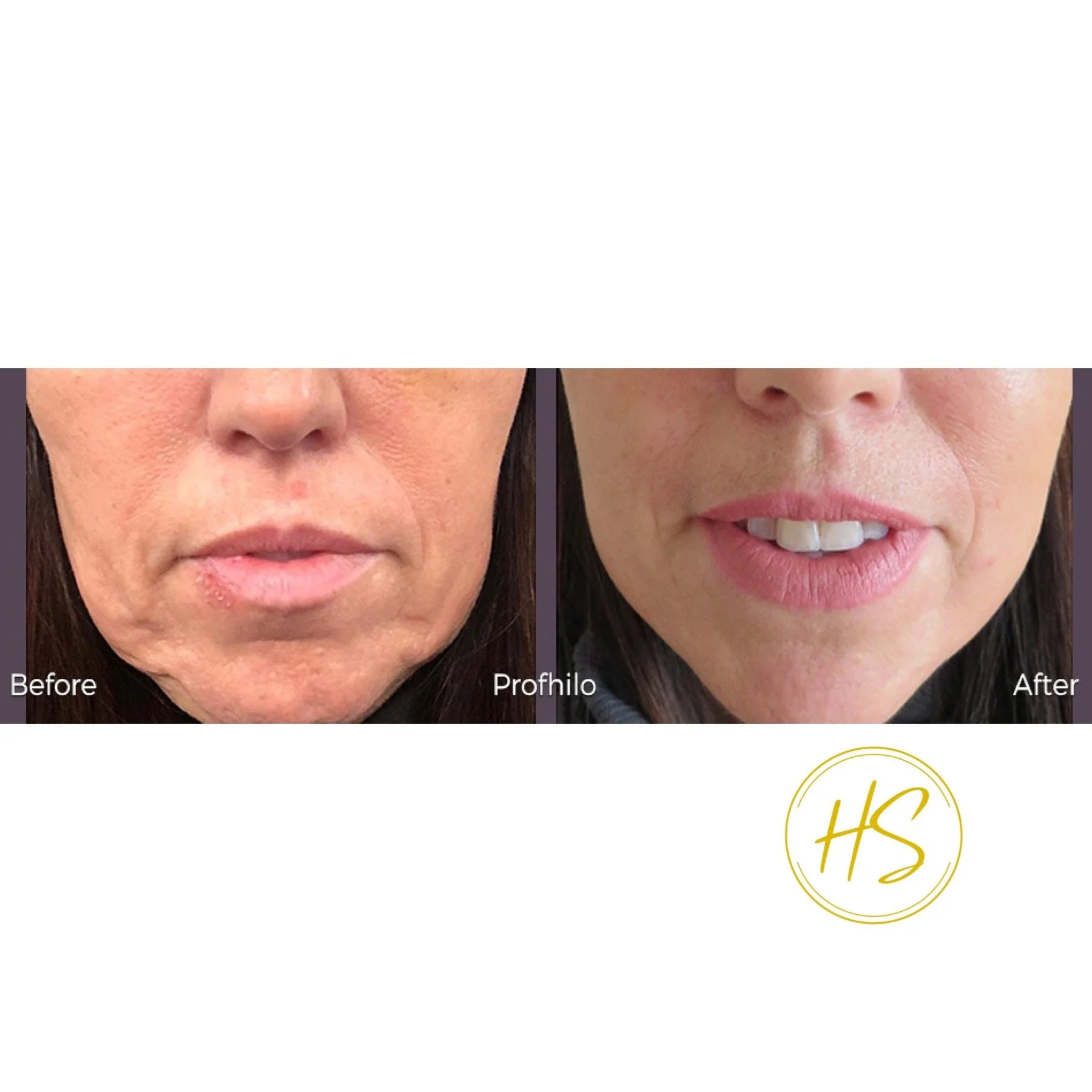 Eye Filler Lumi Eyes Skin Booster Dublin Castleknock