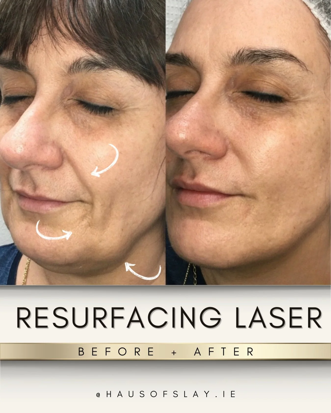 𝗧𝗵𝗶𝘀 𝗶𝘀 𝘄𝗵𝗮𝘁 𝗖𝗢₂ 𝗹𝗮𝘀𝗲𝗿 𝗱𝗼𝗲𝘀 𝘄𝗵𝗲𝗻 𝗶𝘁&rsquo;𝘀 𝗱𝗼𝗻𝗲 𝗽𝗿𝗼𝗽𝗲𝗿𝗹𝘆. ✨

No filters.
No tricks.
Just real skin, rebuilt with precision 🤌🏼

We worked on the areas that were bothering her most &mdash;
pigmentation, under-