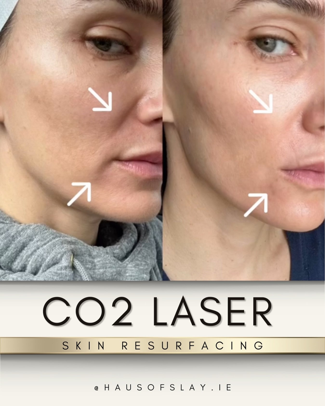 𝗢𝗡𝗘 𝗦𝗘𝗦𝗦𝗜𝗢𝗡. 𝗠𝗜𝗟𝗗 𝗖𝗢₂. 𝗥𝗘𝗔𝗟 𝗔𝗡𝗧𝗜-𝗔𝗚𝗘𝗜𝗡𝗚✨

This is after just ONE session of mild CO₂ fractional laser resurfacing on the mid + lower face &mdash; and the difference is already speaking for itself.

Look closely at the ch