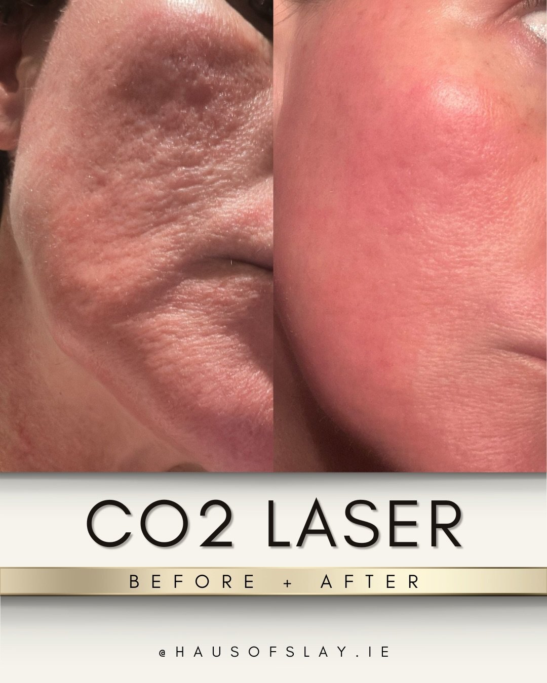 She came to me quietly 🥹👇🏽

No drama. No speech.
Just someone about to start a new job who didn&rsquo;t want her skin to be the thing she thought about every time she walked into a room.

This is ONE session of CO₂ fractional laser resurfacing.

?