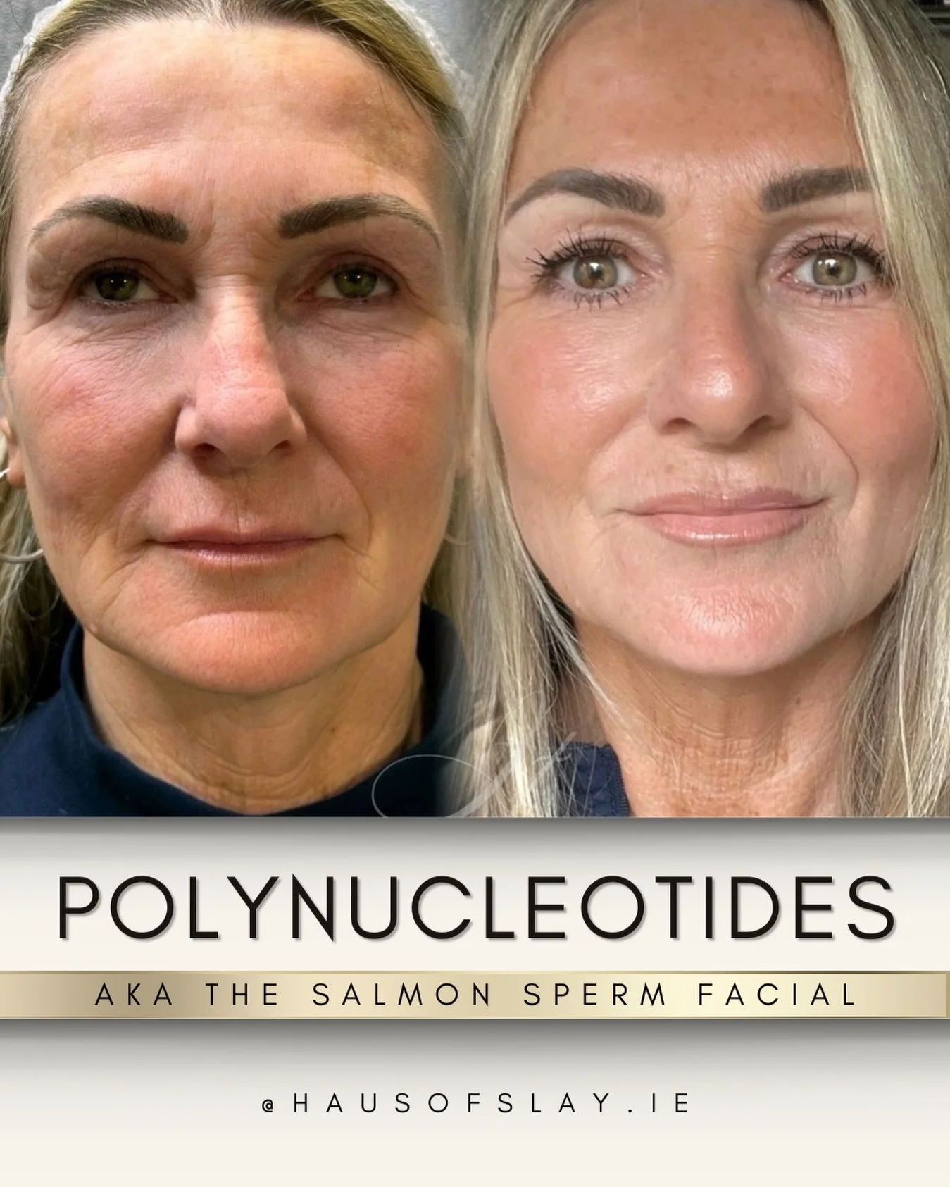 This is what real skin regeneration looks like🧬👇🏽

Not a quick fix.
Not instant.
Not surface-level.

This before &amp; after is the result of 2 microneedling + polynucleotide sessions, spaced 6 weeks apart &mdash; giving the skin the time it needs