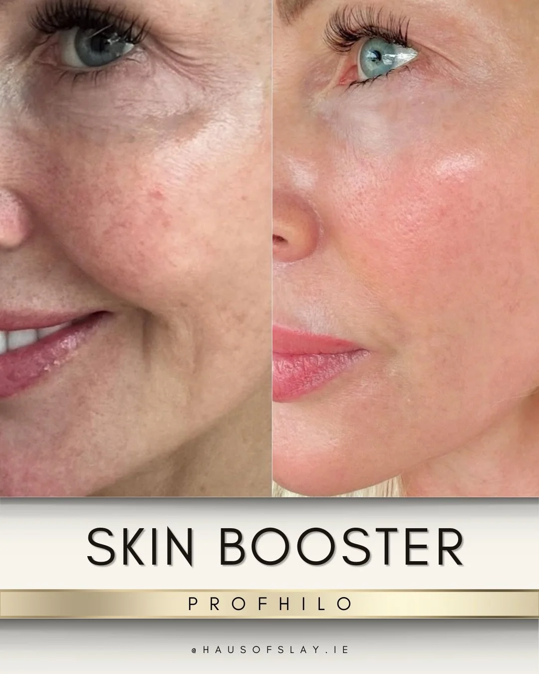 𝗚𝗔𝗟𝗘𝗡𝗧𝗜𝗡𝗘𝗦 𝗖𝗢𝗠𝗕𝗢 𝗢𝗙𝗙𝗘𝗥 𝗥𝗘𝗦𝗨𝗟𝗧𝗦 💘✨

Because why choose between&hellip;
glowy skin and rested under-eyes?

These before + afters show the exact reason this combo is one of my FAVOURITES:

✨ Skin Booster (for overall glow + h