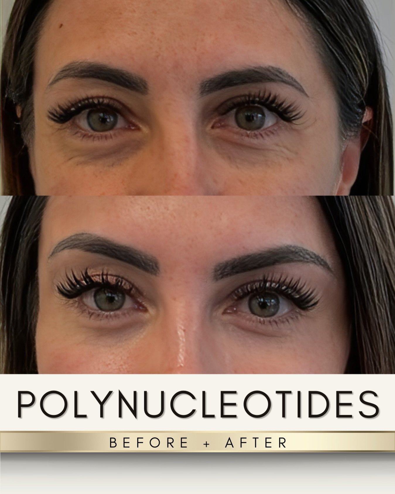 𝗨𝗡𝗗𝗘𝗥-𝗘𝗬𝗘 𝗥𝗘𝗚𝗘𝗡𝗘𝗥𝗔𝗧𝗜𝗢𝗡 🤍✨

No filler.
No &ldquo;pillow face.&rdquo;
No changing your features.

Just better skin.

These results are from polynucleotides under the eyes &mdash; a treatment designed to improve thin, crepey, tired-