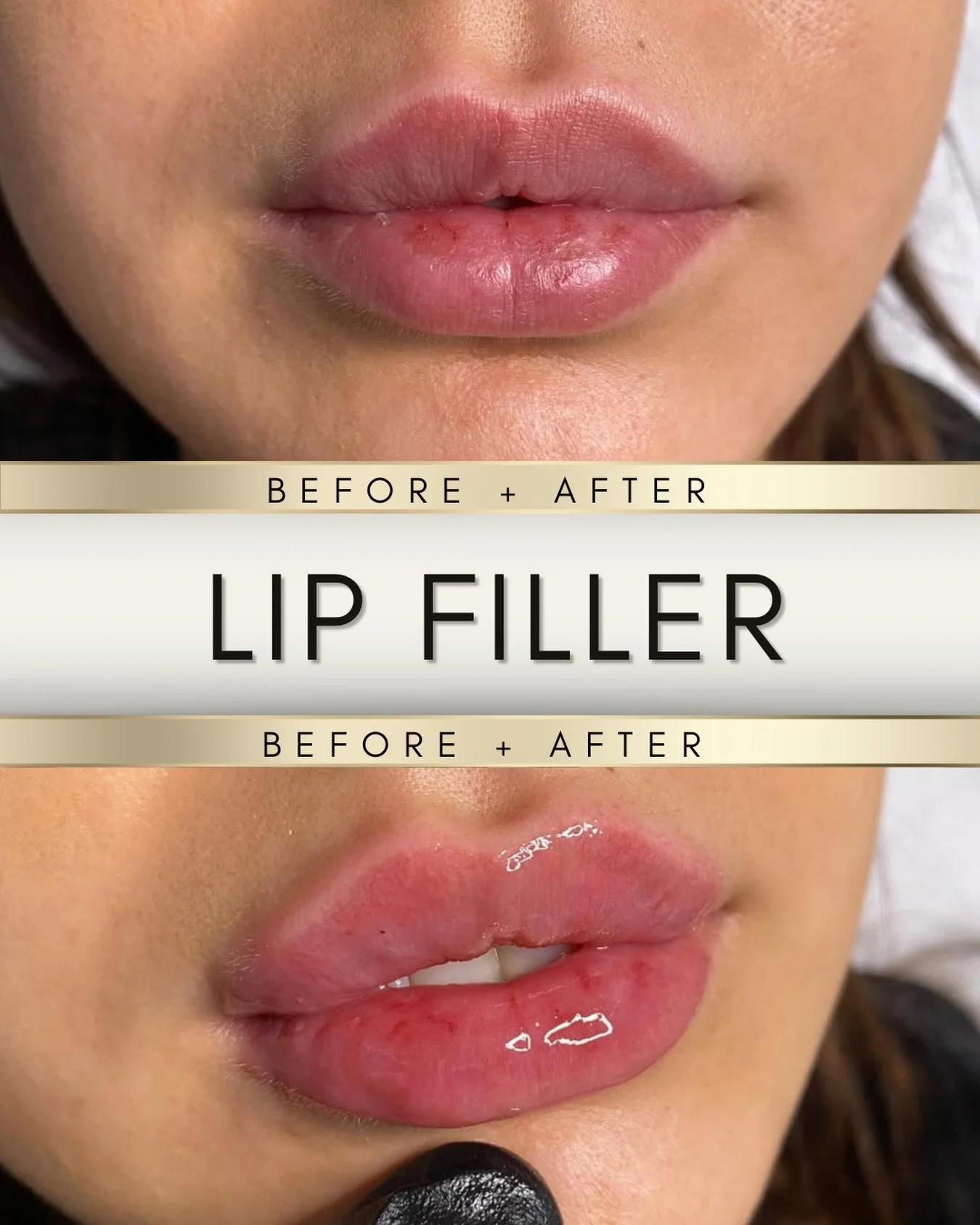 The goal was never bigger. The goal was better.

Because this is EXACTLY what so many of you mean when you say you want your lips done 🤌🏼

Not huge.
Not puffy.
Not obvious.

Just better shape, better balance, and that soft juicy little upgrade that
