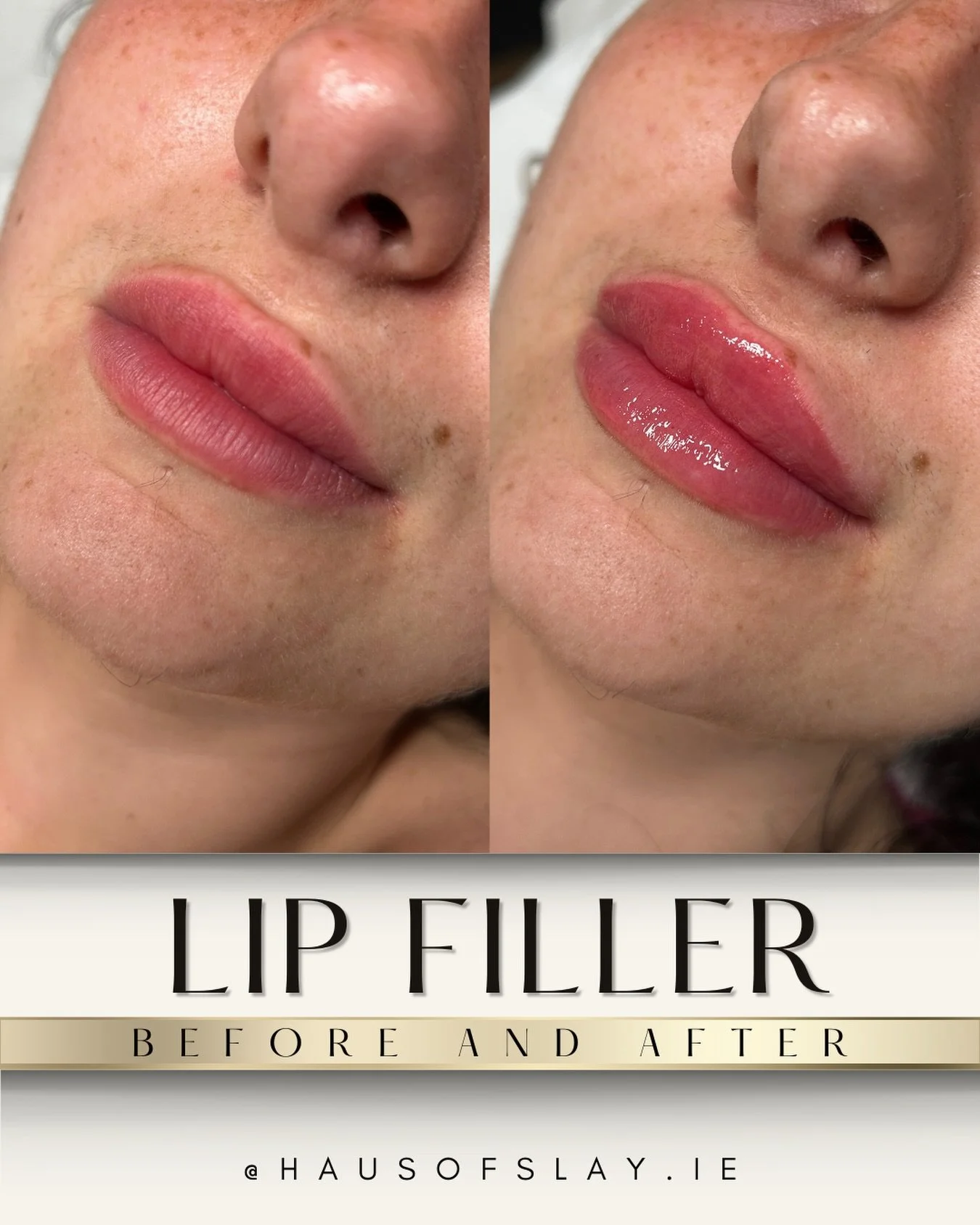 𝗧𝗵𝗲 𝗴𝗼𝗮𝗹 𝘄𝗮𝘀 𝗻𝗲𝘃𝗲𝗿 &ldquo;𝗯𝗶𝗴𝗴𝗲𝗿,&rdquo; 𝗵𝘂𝗻𝗻𝗶𝗲. 𝗜𝘁 𝘄𝗮𝘀 𝗯𝗲𝘁𝘁𝗲𝗿. 💋

Because this is what so many of you actually mean when you say you want lip filler.

Not stiff.
Not puffy.
Not obviously filled.

Just a prettie