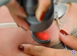 Fractional CO2 Resurfacing eyes face lips