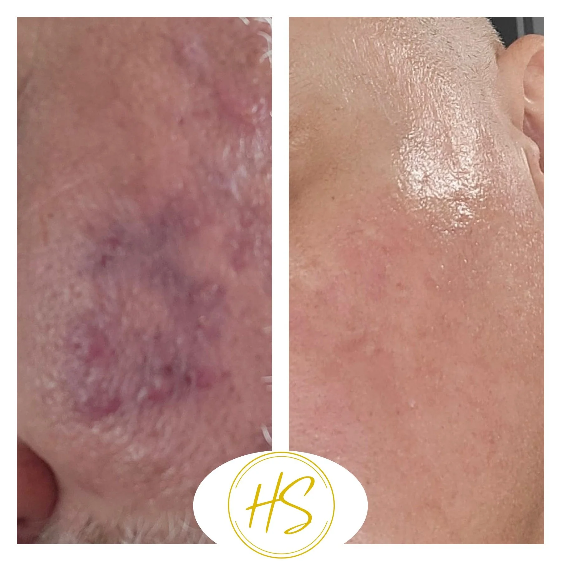 Exosomes polynucleotides Hair Face