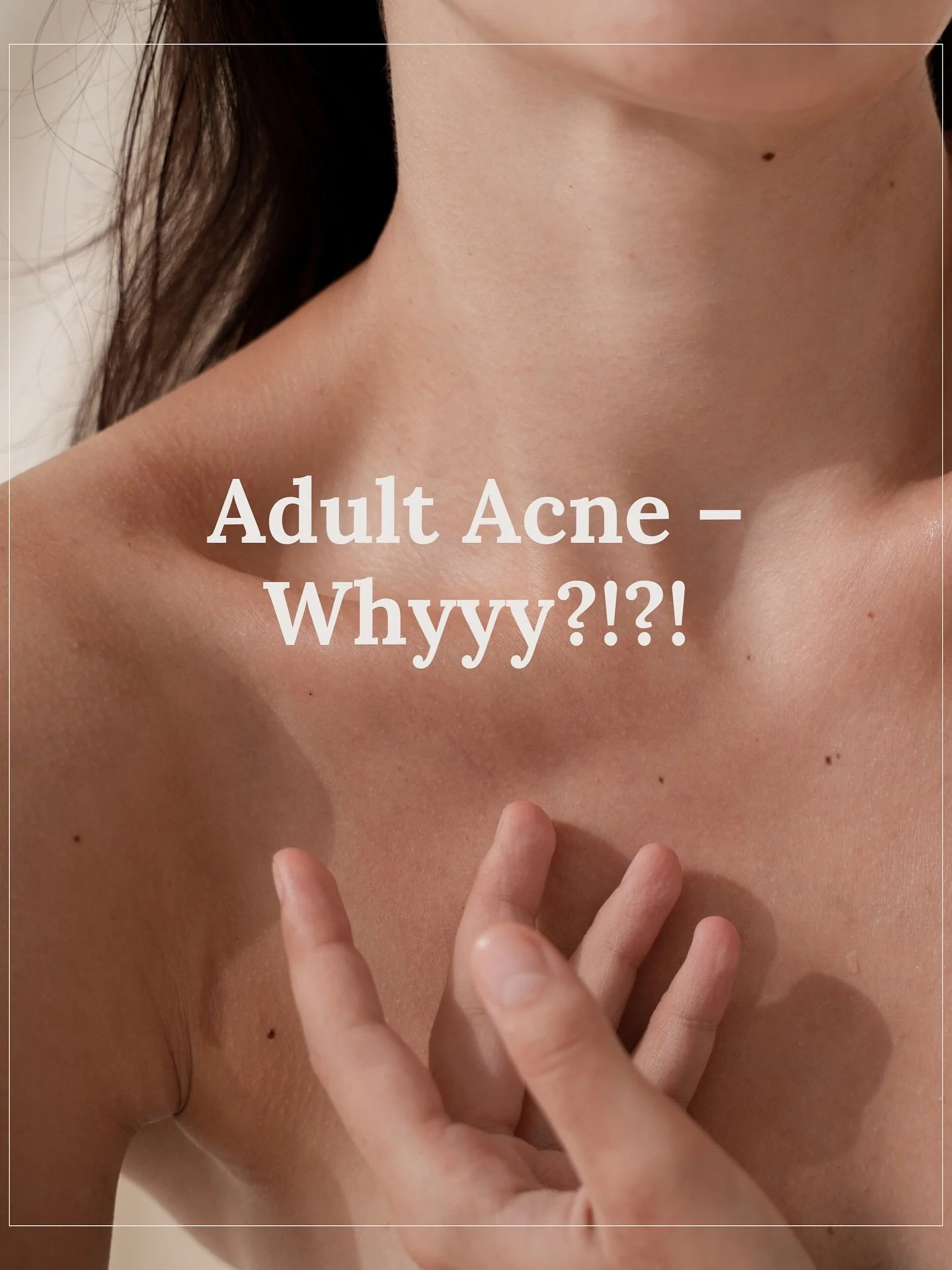 Adult acne&hellip; whyyy?! 😫👀 
You&rsquo;ve changed your pillowcase (twice).
You&rsquo;re single-handedly keeping Mecca in business.
You even broke up with cheese for a hot minute. 🧀💔  &hellip; but your skin didn&rsquo;t get the memo (rude). 
Her